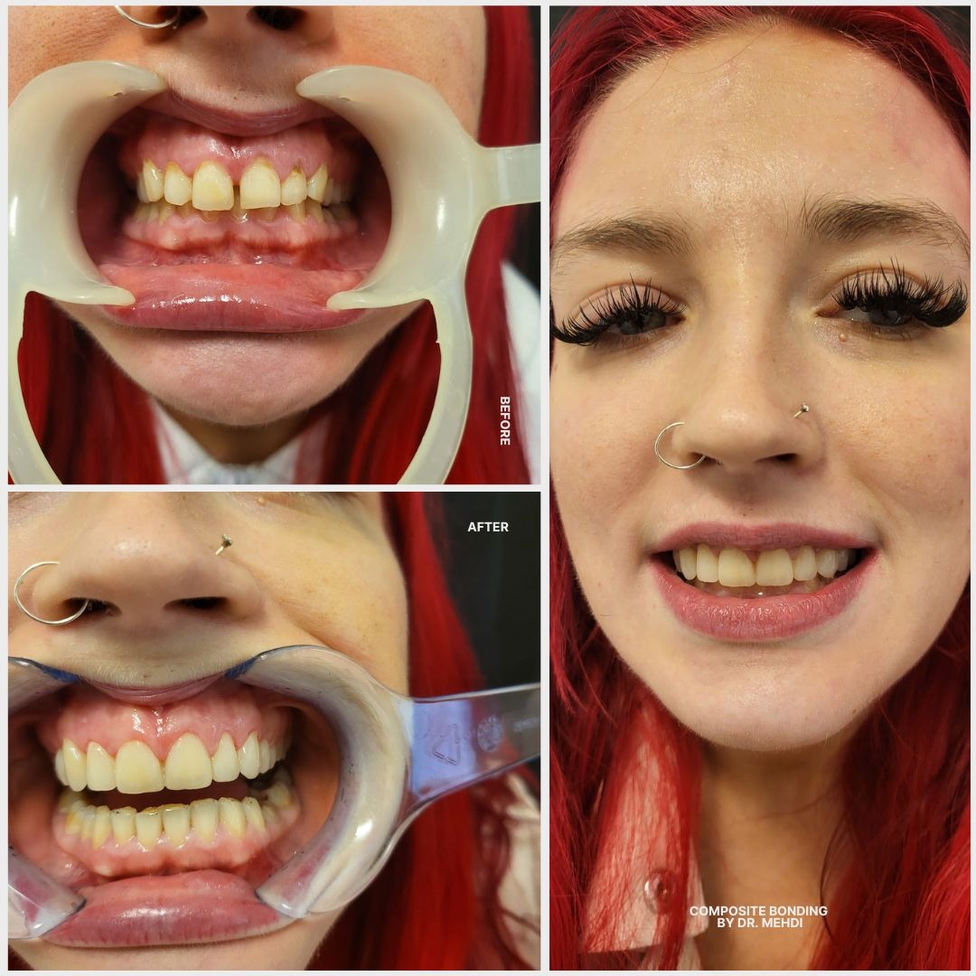 Pure Porcelain Crowns London