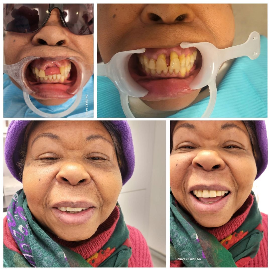Pure Porcelain Crowns London