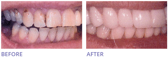 Home Zoom Teeth Whitening Before After Image