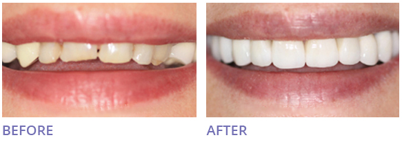 Home Zoom Teeth Whitening Before After Image