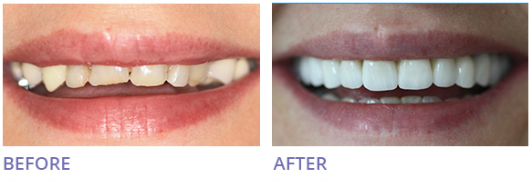 Home and Office Zoom Teeth Whitening Before After Image