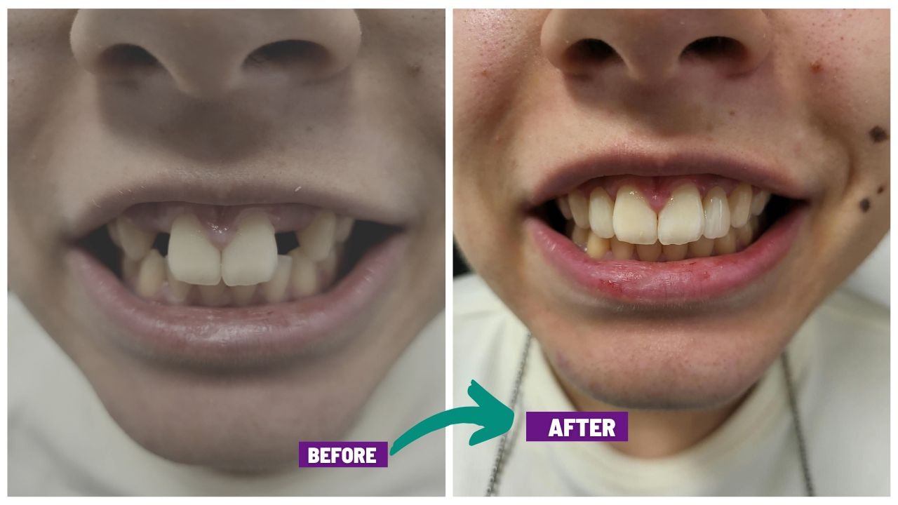 Pure Porcelain Crowns London