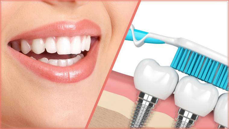 Cosmetic dentistry with dental implants