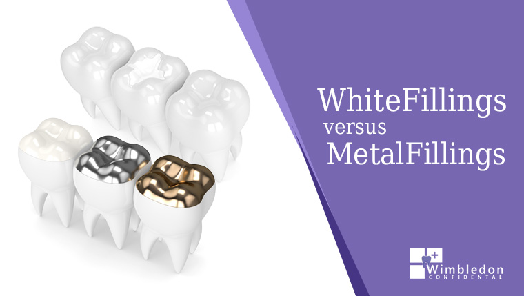 White versus Metal Fillings